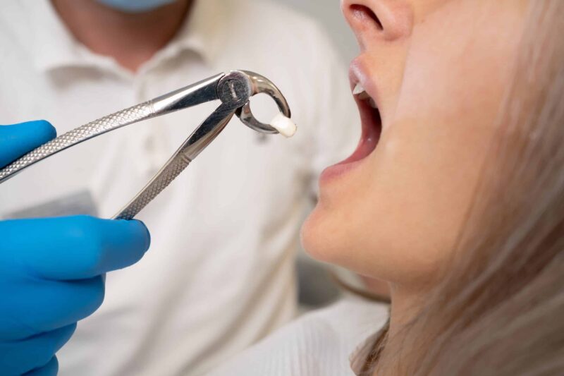 Gentle Tooth Extractions Nashville