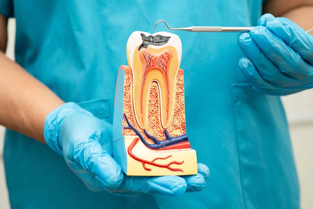 Root Canal Therapy Nashville